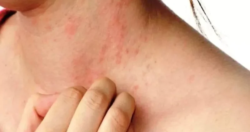 Summer Skin Problems: How To Prevent Heat Boils On Face