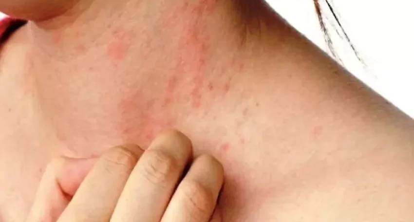 Summer Skin Problems: How To Prevent Heat Boils On Face