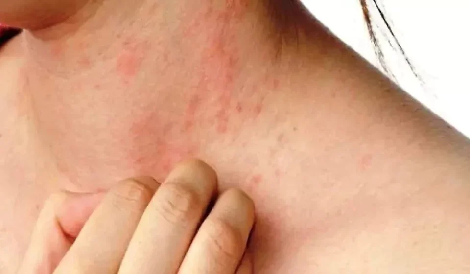 Summer Skin Problems: How To Prevent Heat Boils On Face