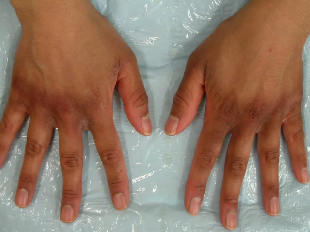 Hand Pigmentation