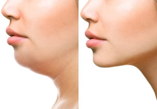 Double Chin Reduction