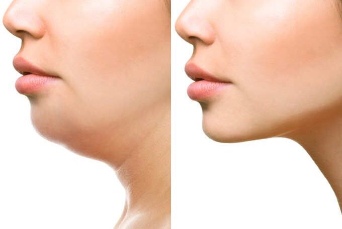 Double Chin Reduction
