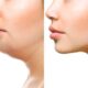 Double Chin Reduction