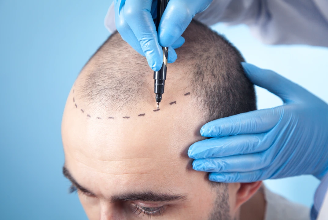 Hair Transplant