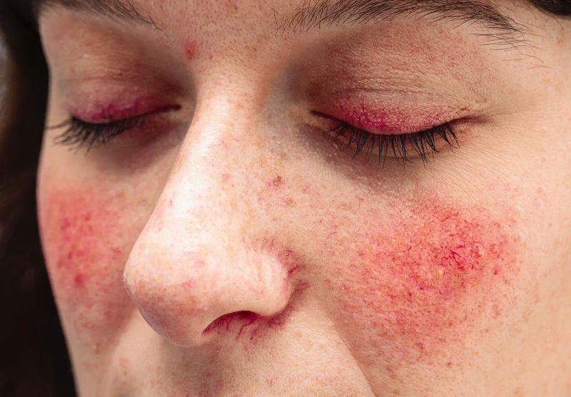 Rosacea