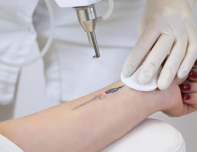 Tattoo Removal
