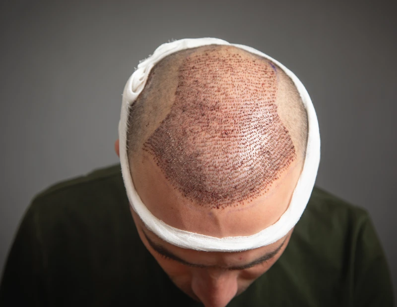 hair transplant