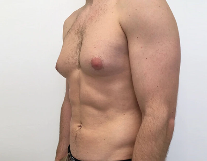 Gynecomastia Surgery