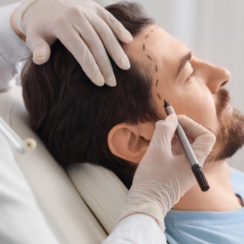 Hair Transplant