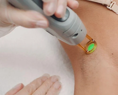 laser treatment-1