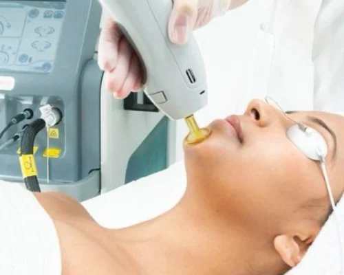 laser treatment